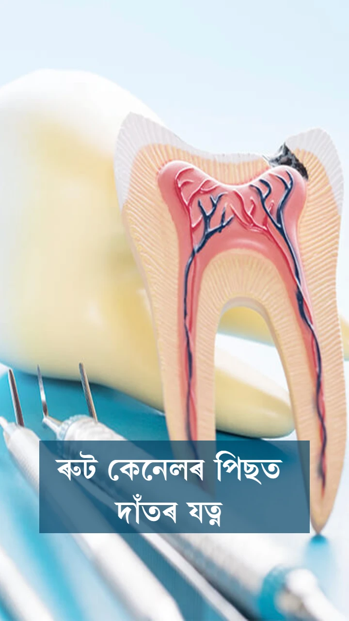 ৰুট কেনেলৰ পিছত দাঁতৰ যত্ন 